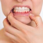 Dealing With Discolored Permanent Teeth In Children